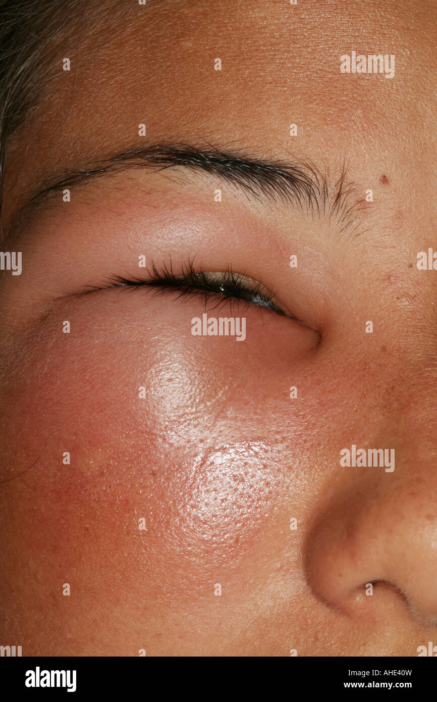 Skind enflé autour d'un oeil les filles en raison d'une réaction allergique  à une piqûre de moustique commun Photo Stock - Alamy