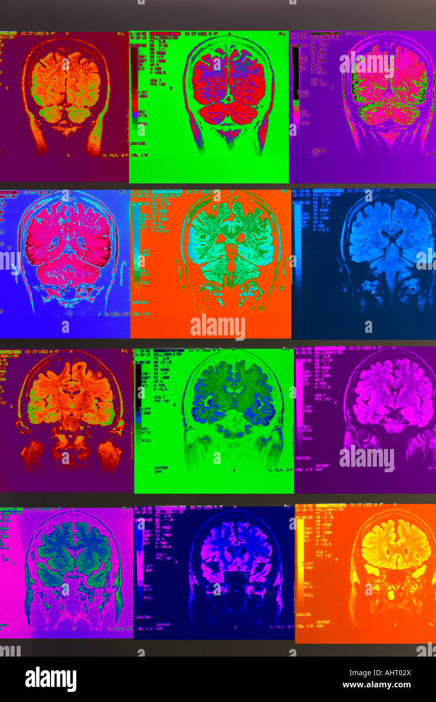 Les rayons colorés de cortex cérébral cervelet IRM du cerveau humain Banque D'Images