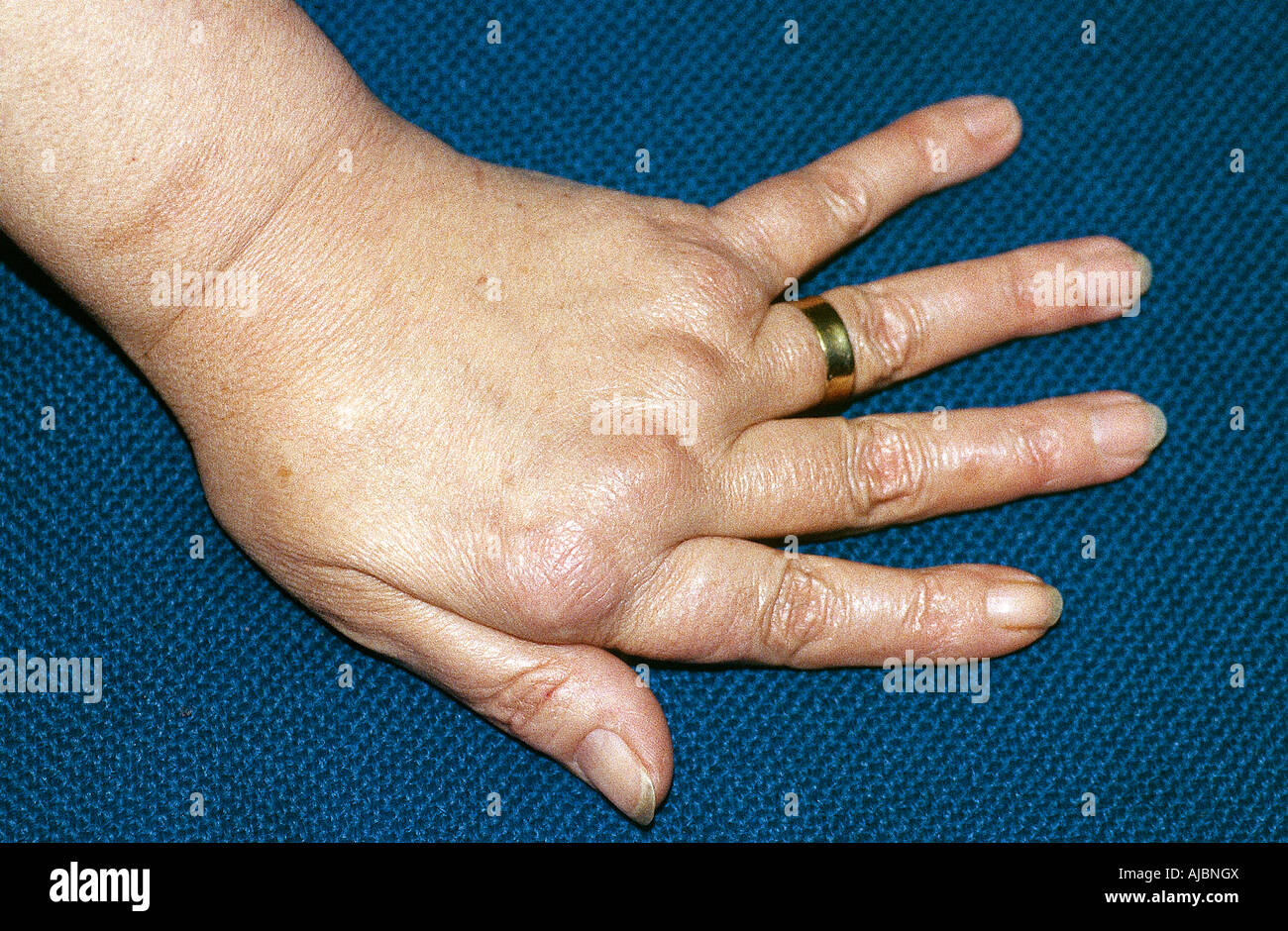 L'arthrite rhumatoïde grave menant à la dérive ulnaire, avant remplacement de l'articulation MCP Banque D'Images