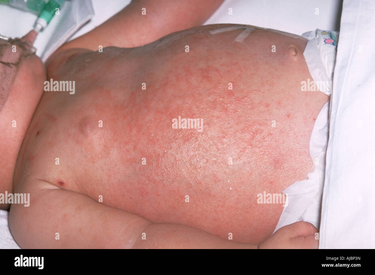 Une photographie d'un bébé atteint d'une septicémie à méningocoques