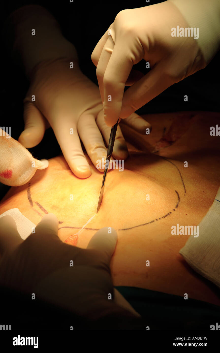L'utilisation du scalpel chirurgien de faire première incision dans patient pendant l'opération chirurgicale majeure Banque D'Images