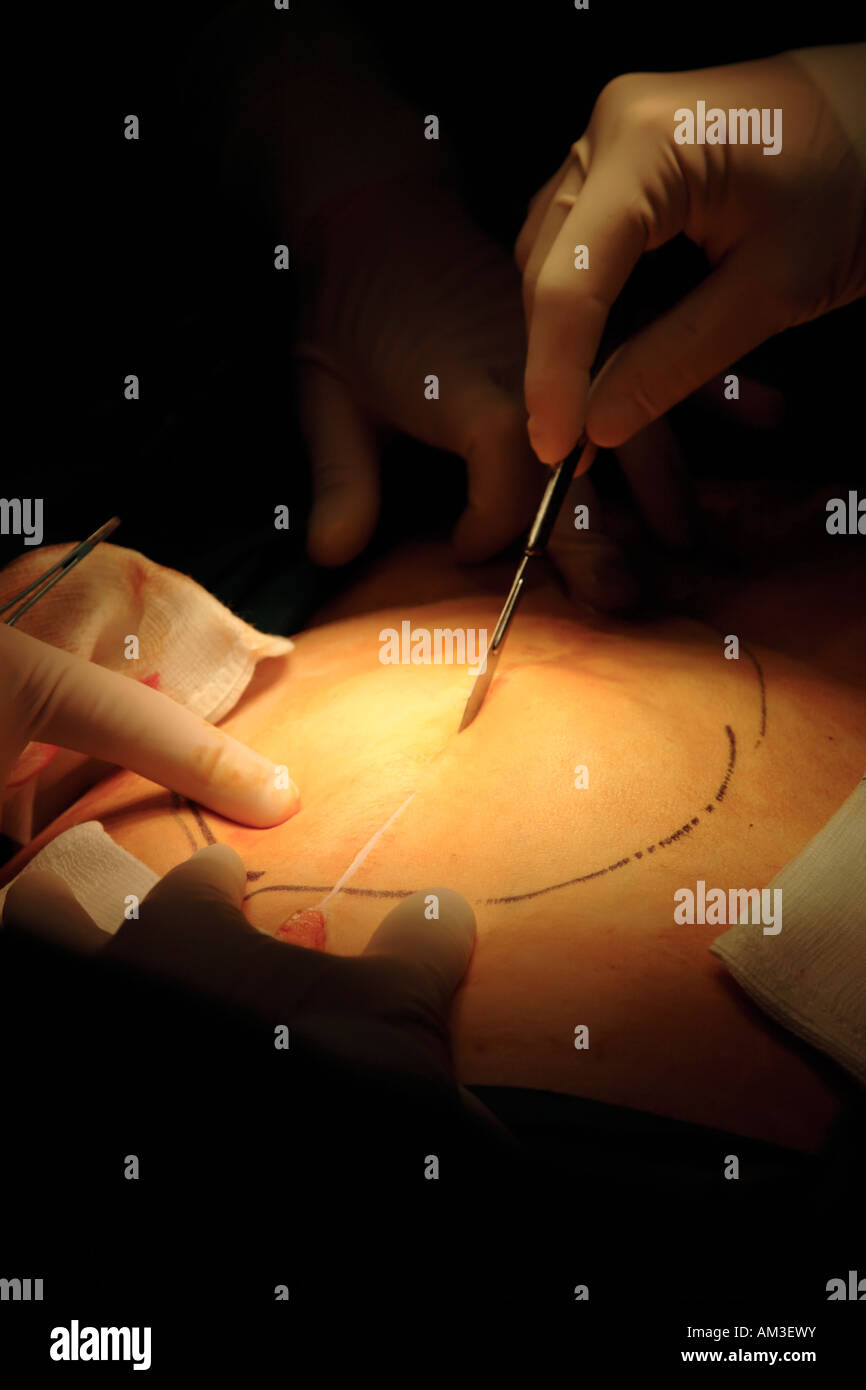 Chirurgien fait première incision dans l'utilisation du scalpel patient en salle d'opération Banque D'Images