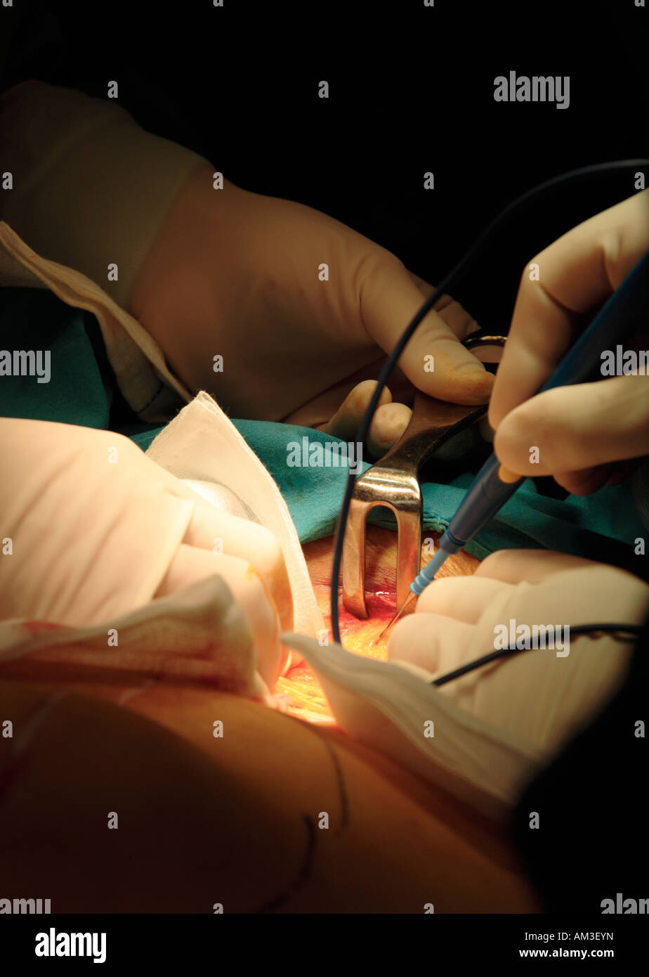 À l'aide d'un chirurgien scalpel pour couper à travers le péritoine, d'entrer dans la cavité abdominale Banque D'Images