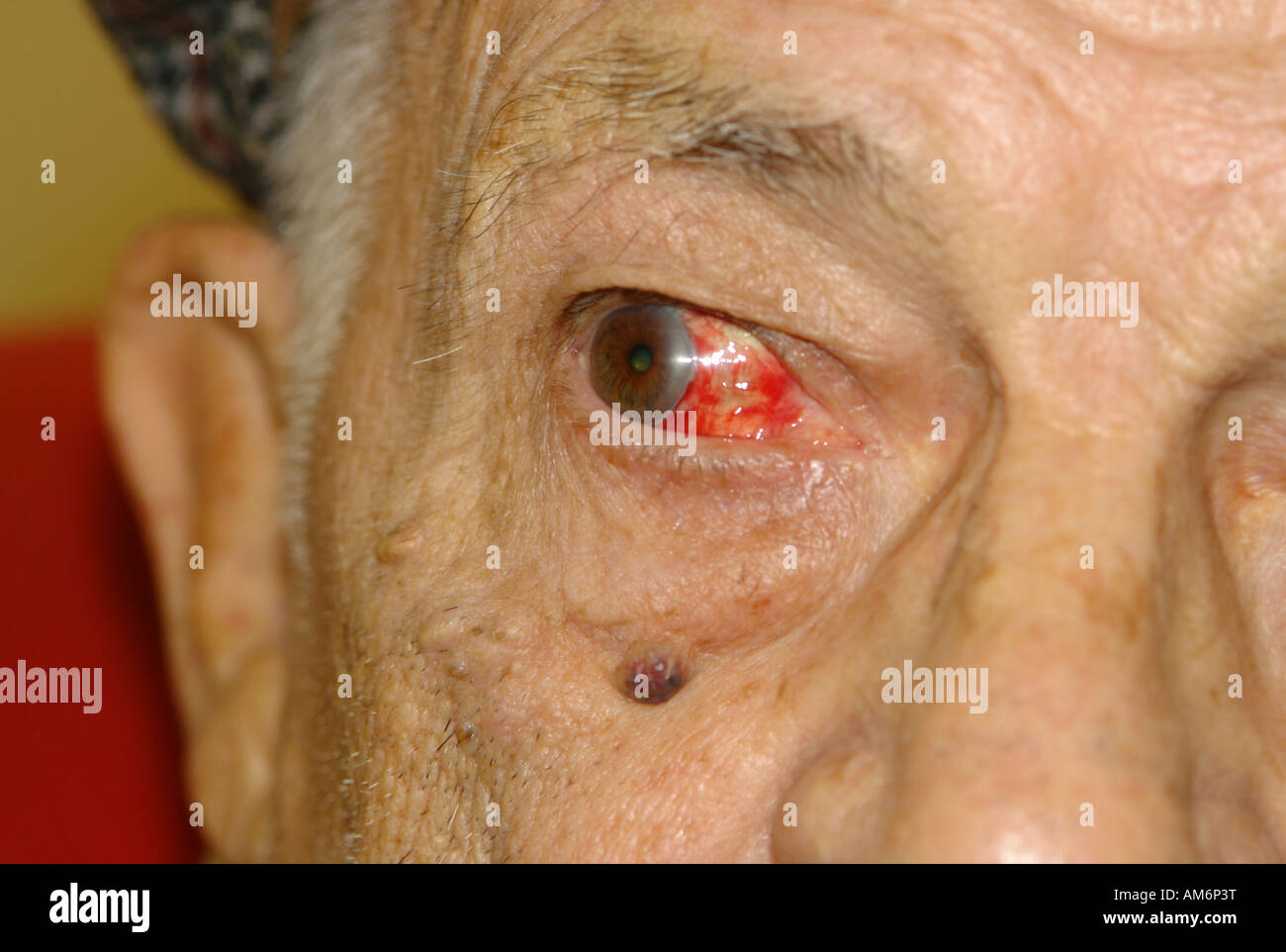 Vaisseau sanguin cassé dans l