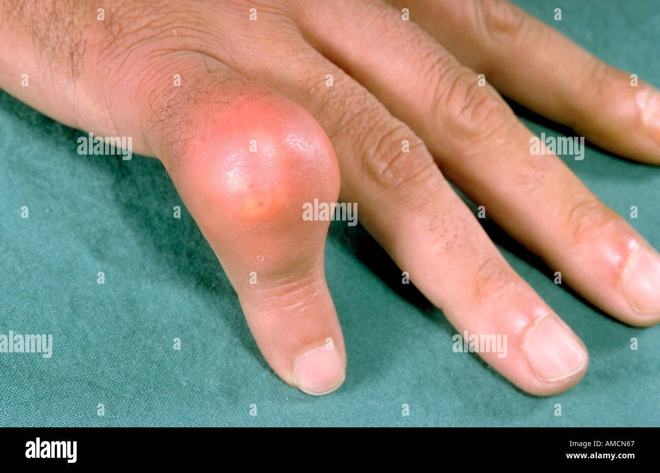 Goutte aiguë Banque D'Images