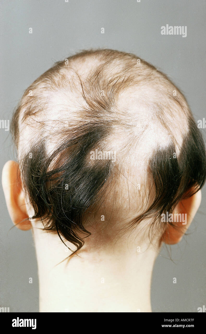 Une photographie d'une femme avec la pelade, également appelée alopécie circumscripta. Banque D'Images