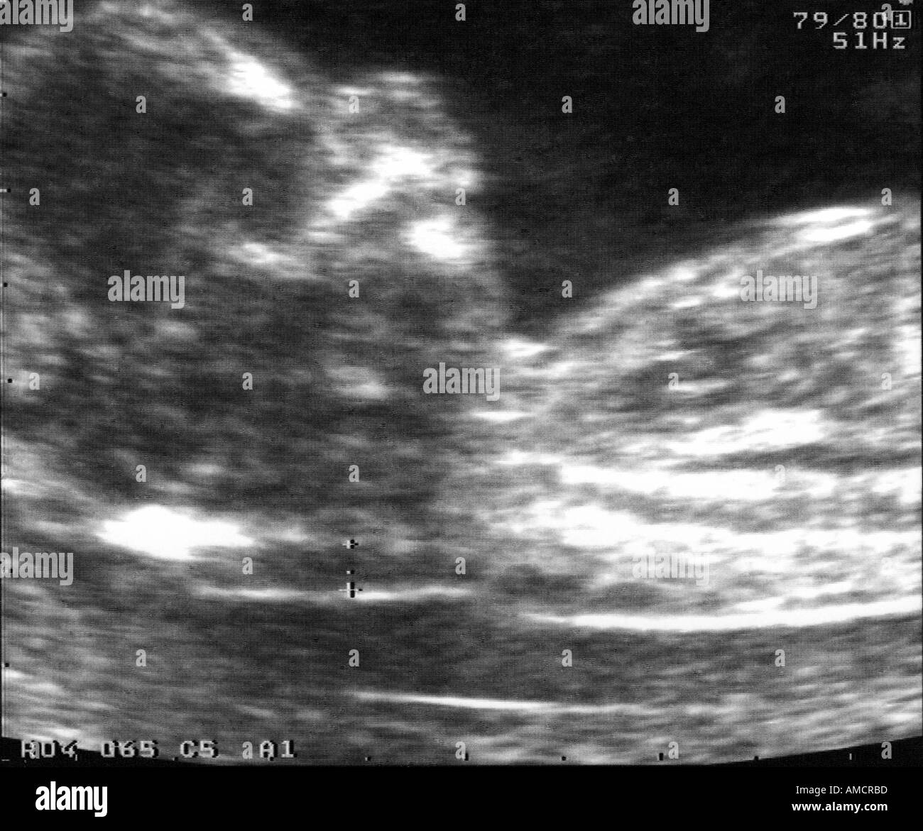 La clarté nucale une échographie à 12 semaines de grossesse, montrant un bébé avec une augmentation de la clarté nucale fois et la micrognathie. Banque D'Images