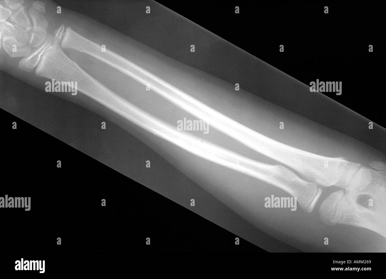 X ray greenstick fracture de l'avant-bras Banque D'Images