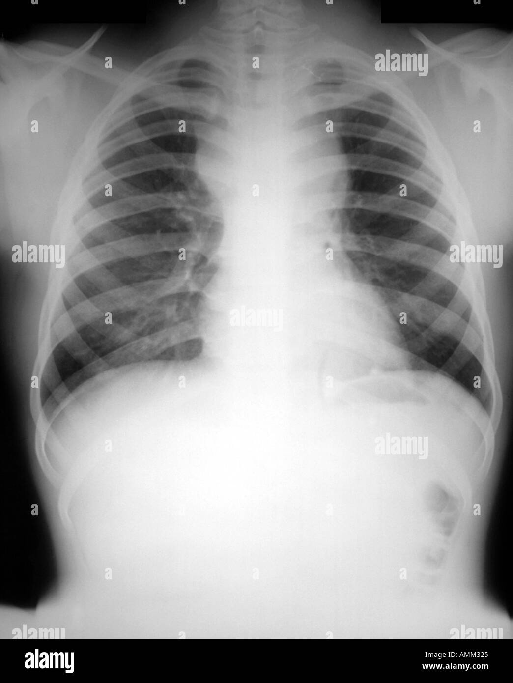 Rayons X de la poitrine avant la radiothérapie la maladie de Hodgkin Banque D'Images