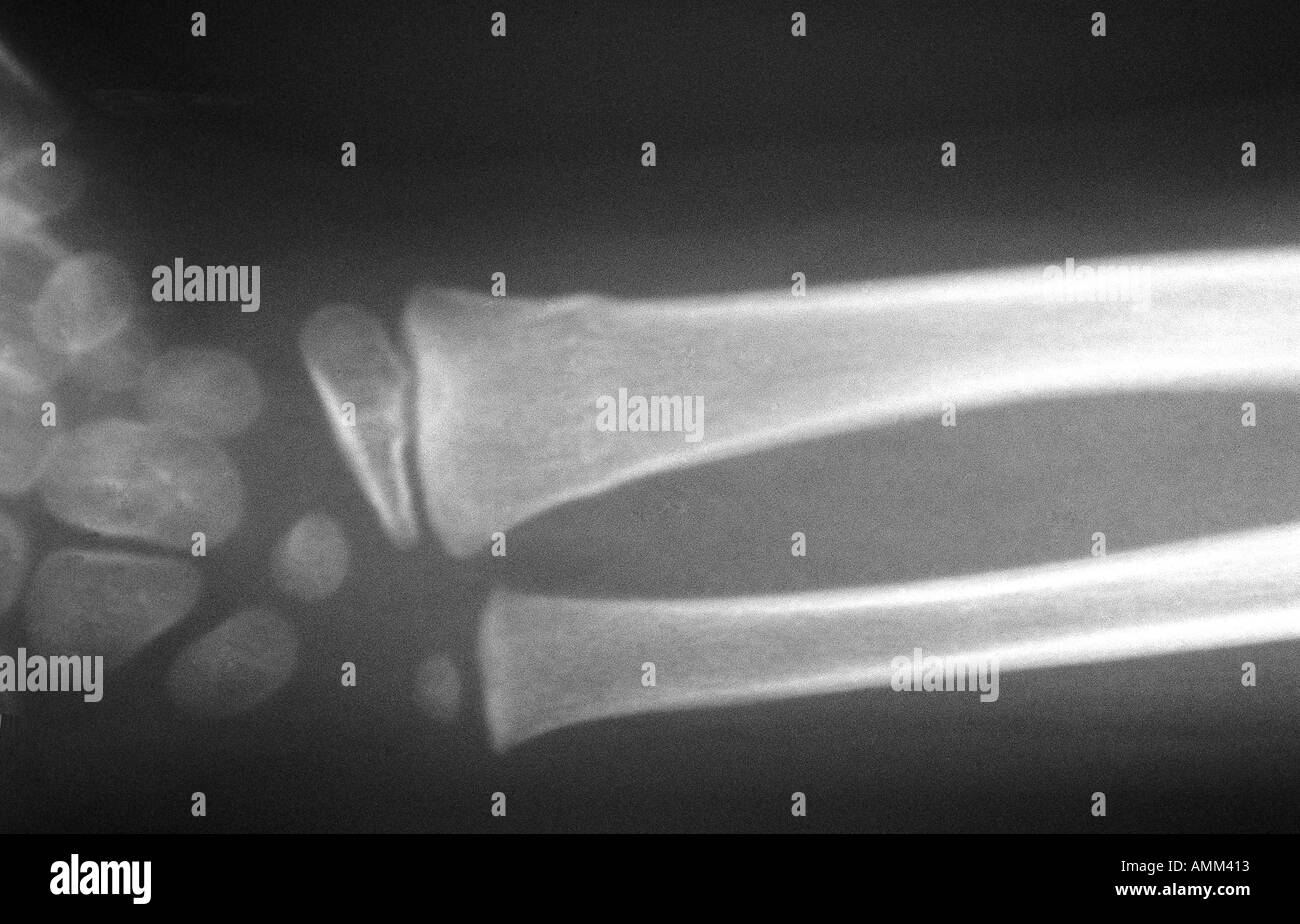 X ray enfant Fracture poignet tore Banque D'Images