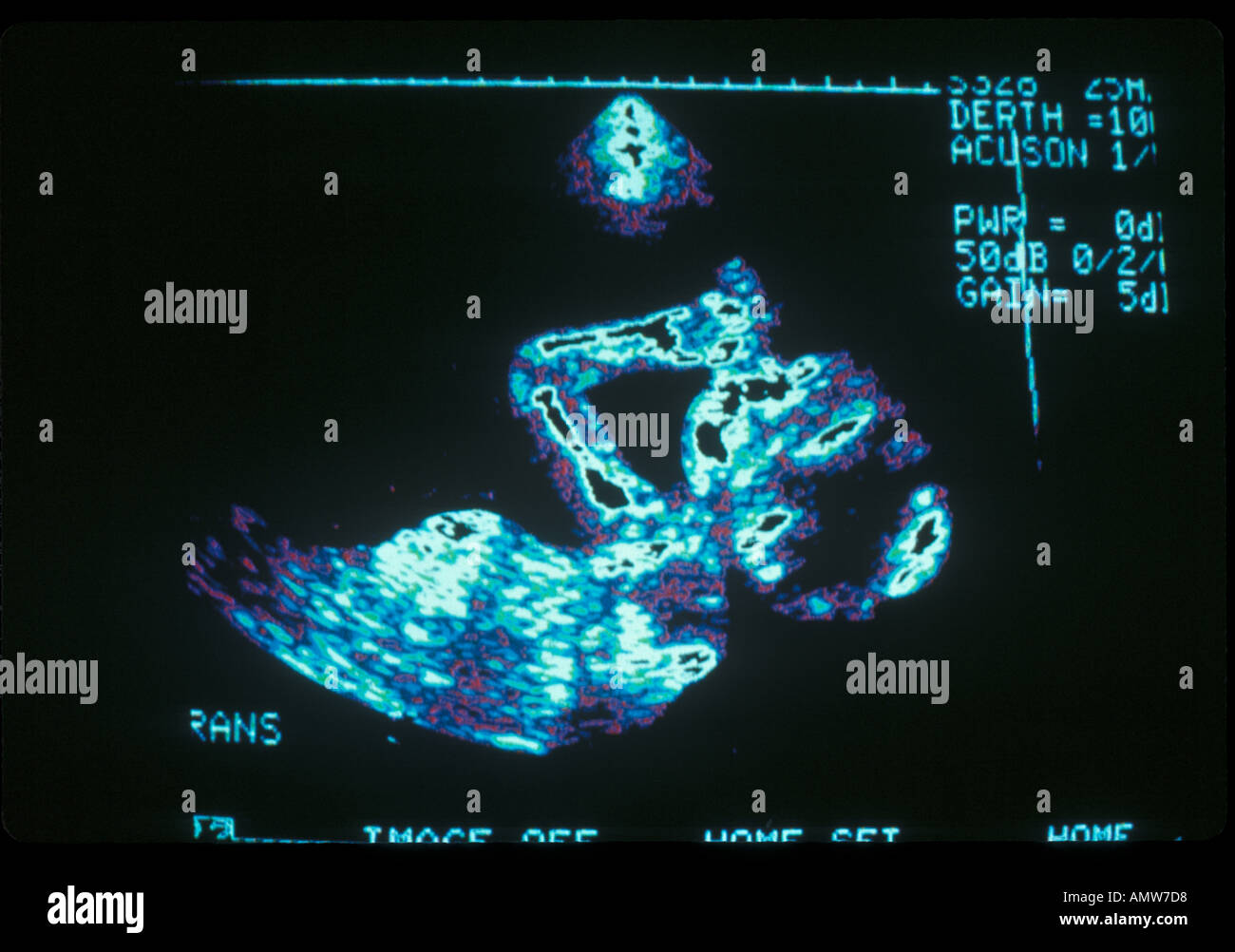 Échographie foetus foetus sucking thumb 30 semaines Banque D'Images