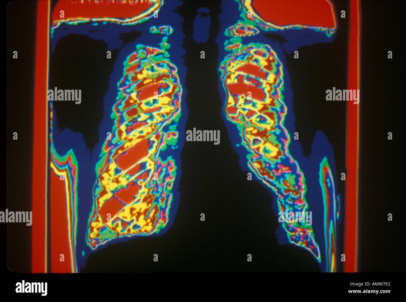 PneumoniaI poumon infecté Banque D'Images