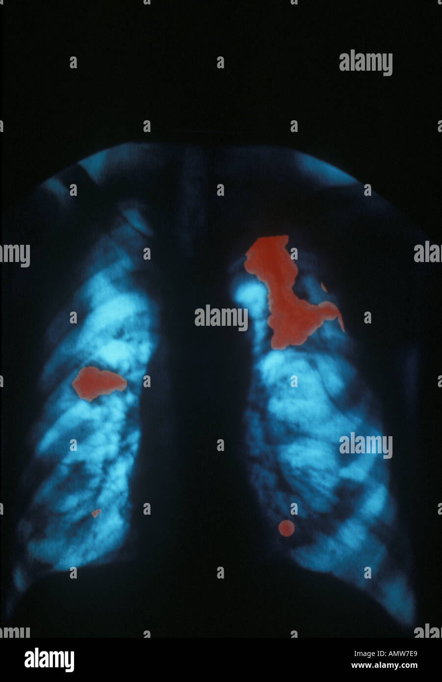 Le cancer du poumon X ray Banque D'Images