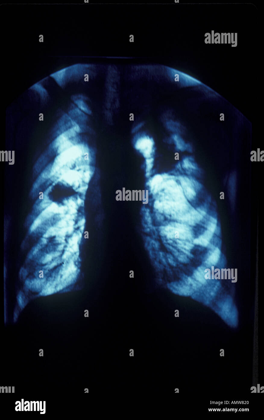 Xray zones noires sont le cancer du poumon Banque D'Images