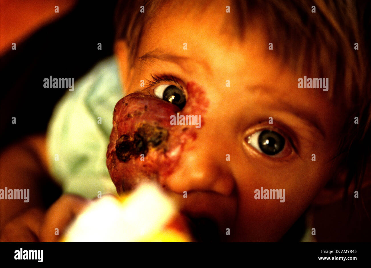 SHABANA KABOUL DIAGNOSTICS 06 août 2005 Shabana une jeune fille afghane de neuf mois a été diagnostiqué avec une Leishmaniose Banque D'Images