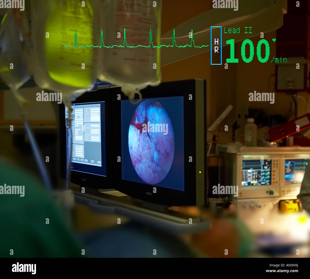 Écran d'ordinateur et de contourner la chirurgie cardiaque Banque D'Images