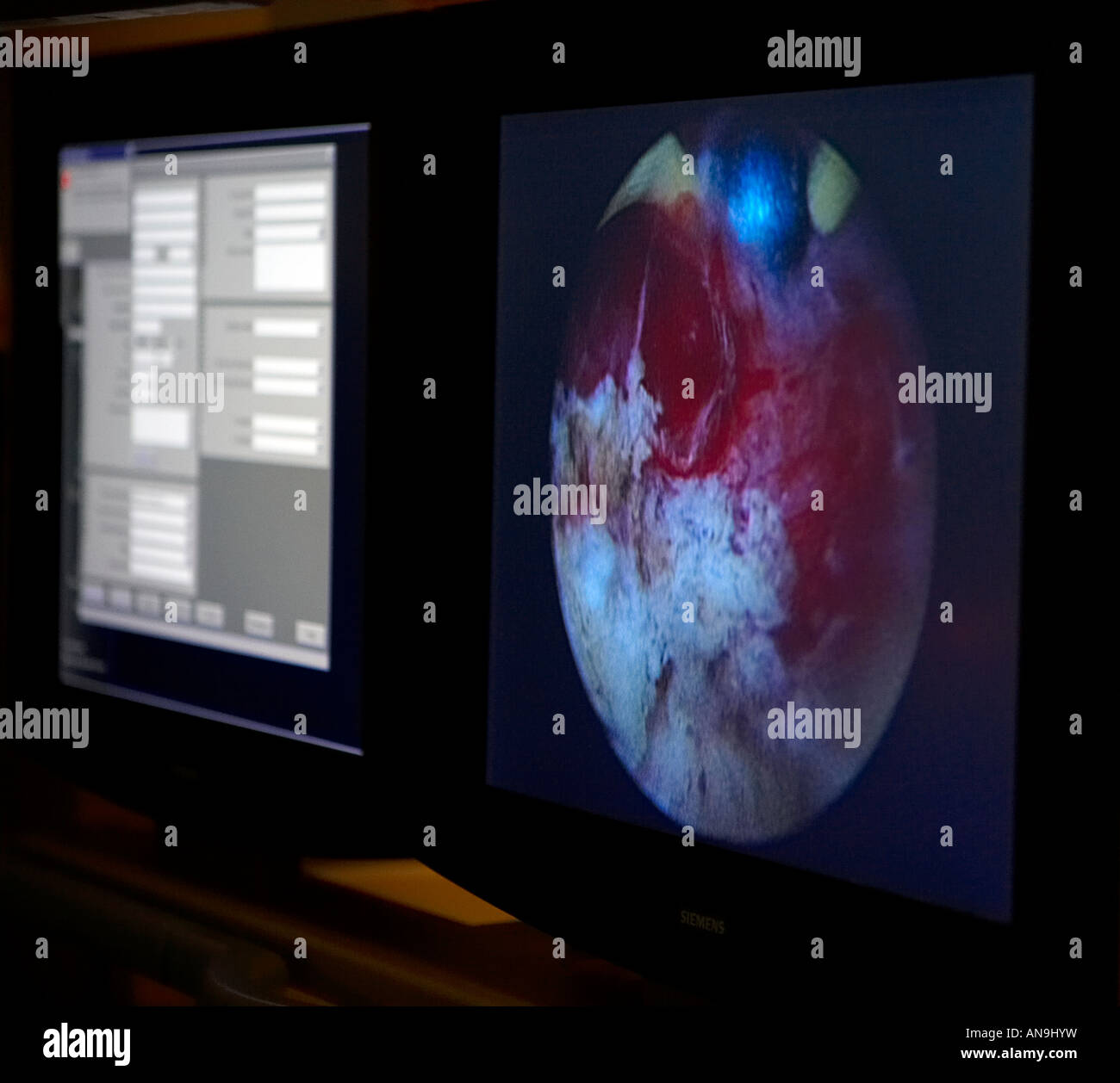 Écran d'ordinateur et de contourner la chirurgie cardiaque Banque D'Images