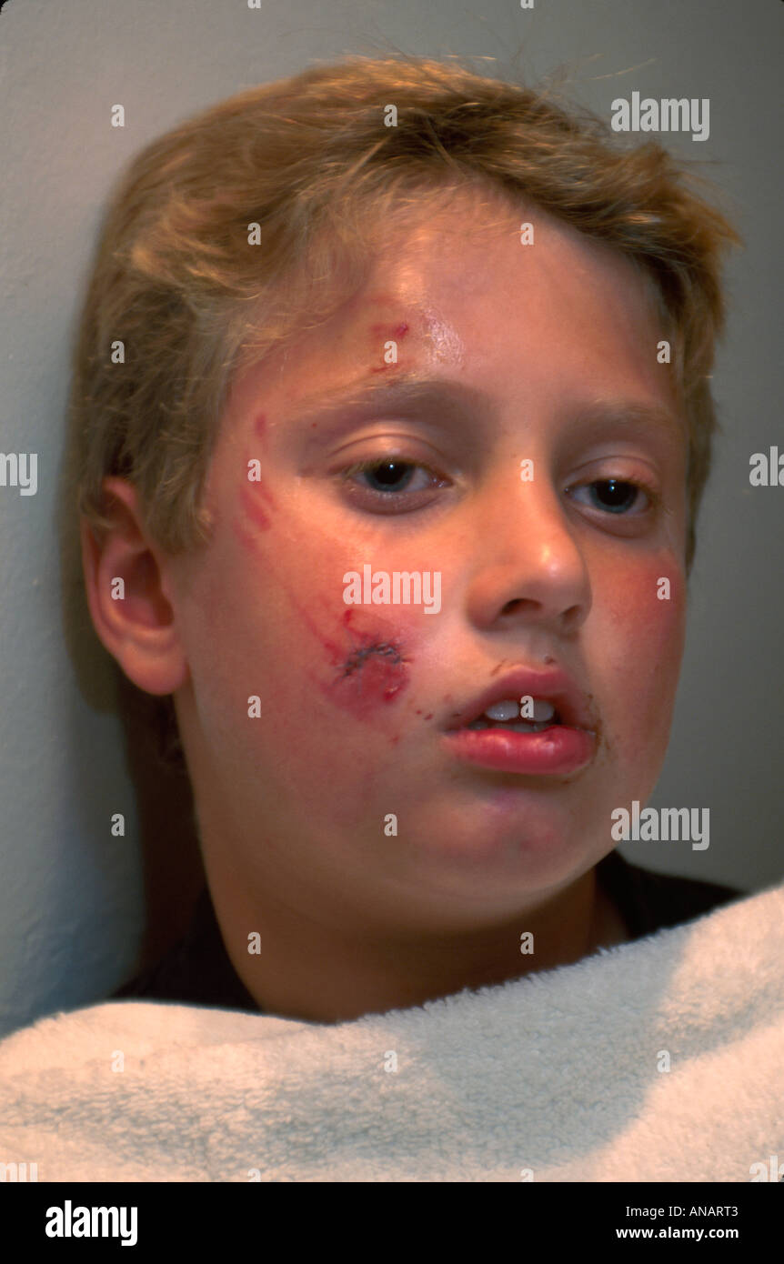 Blessure par morsure de chien Banque de photographies et d’images à