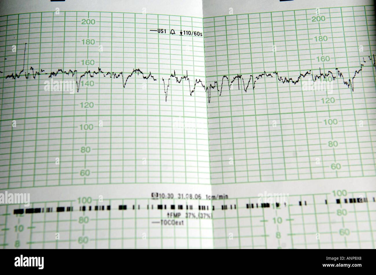 Électrocardiographe ecg moniteur de fréquence cardiaque grossesse maternité  bébé enfant à naître l'impression de lire la vie de signal concept editori  Photo Stock - Alamy