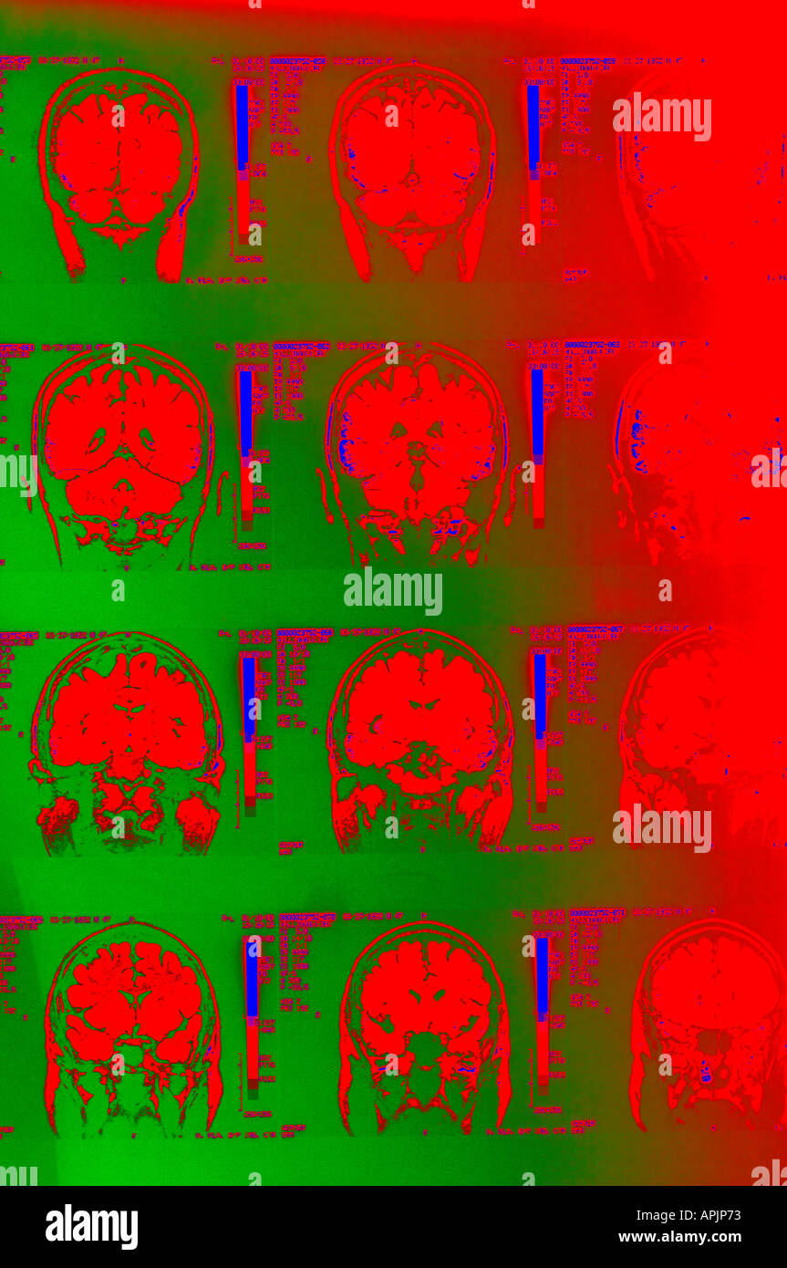Les rayons colorés de cortex cérébral cervelet IRM du cerveau humain Banque D'Images