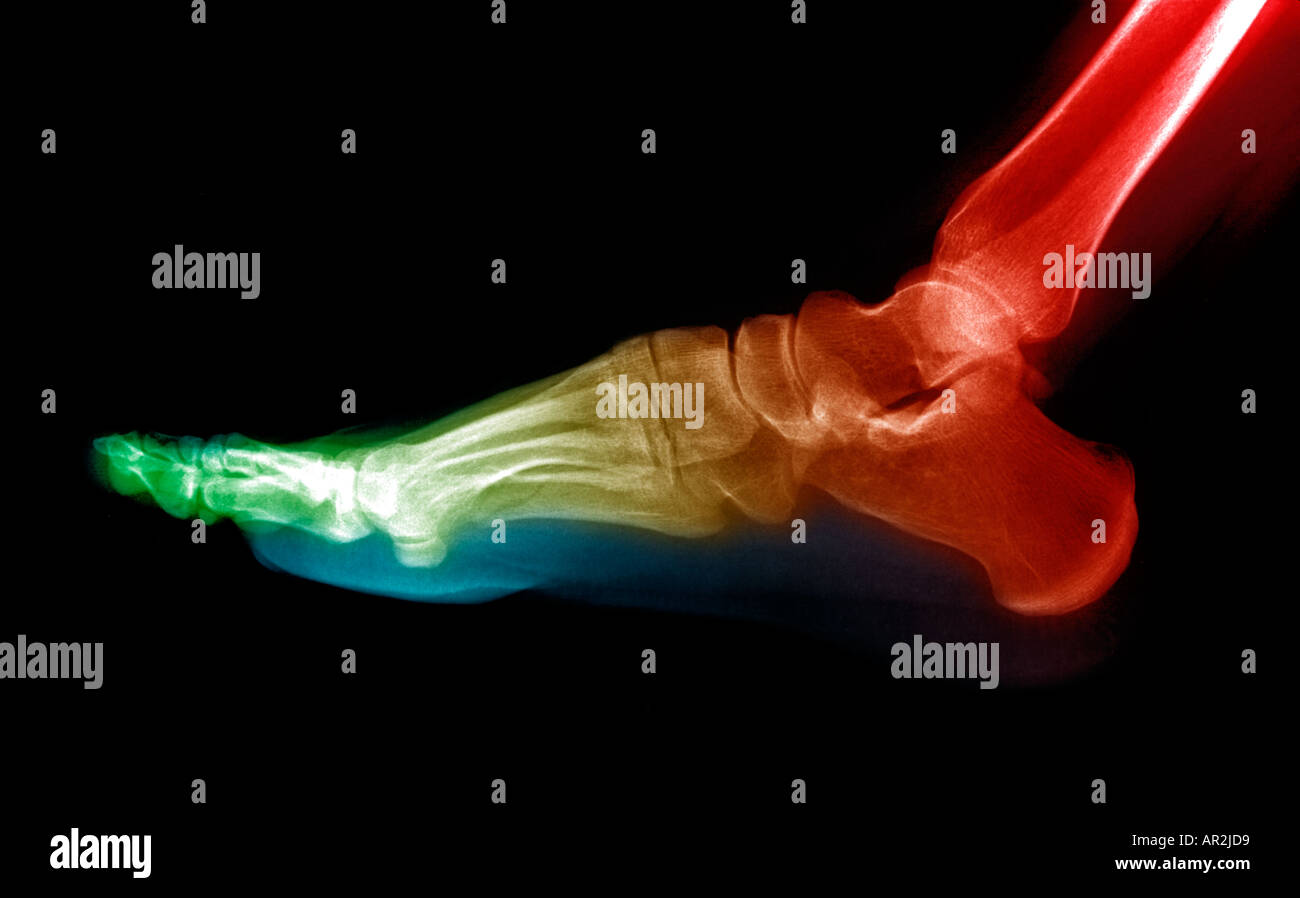 Radiographie : radiographie du pied humain Banque D'Images