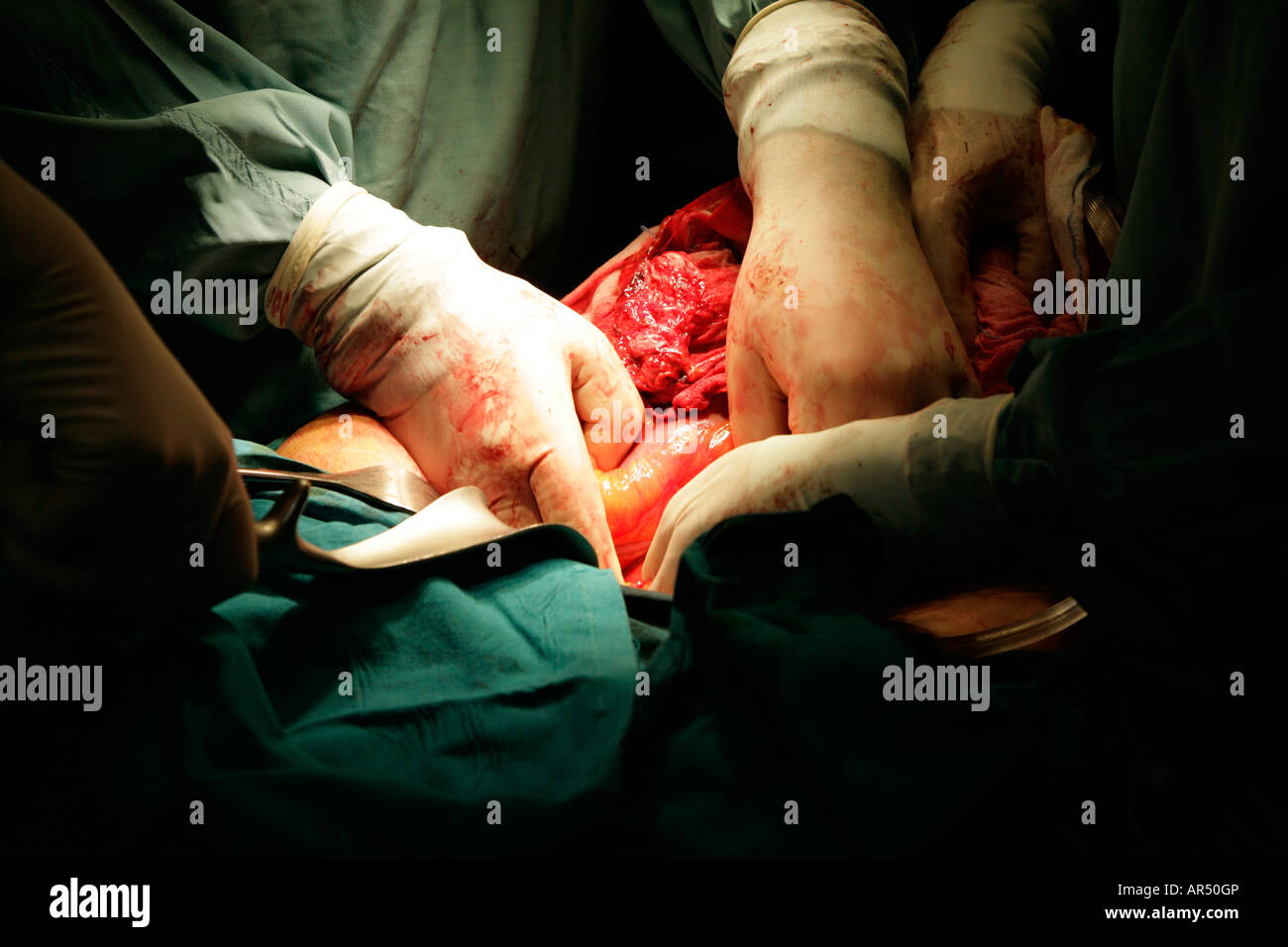 Levage de chirurgiens côlon ascendant à partir de la cavité abdominale pendant l'opération du cancer Banque D'Images