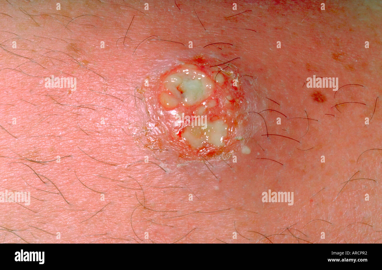 Une photographie d'un homme avec le VIH et d'un Ecthyma Staph aureus furoncle sur l'épaule. Banque D'Images