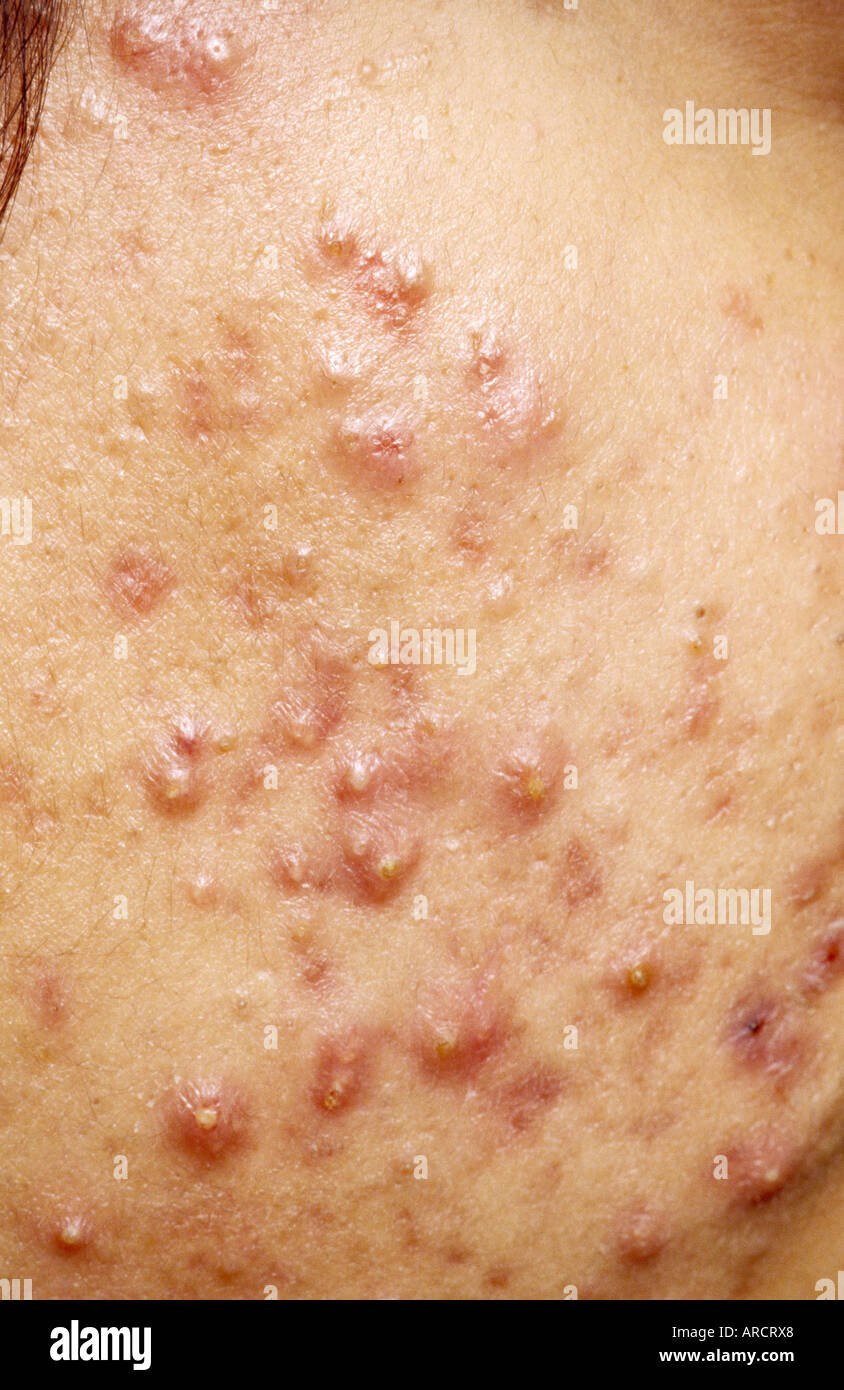 Une photographie de l'acné vulgaris, la forme la plus commune de l'acné qui comprend plusieurs types de boutons. Banque D'Images