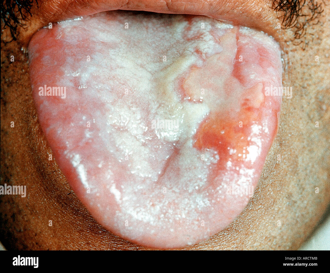 Aphtes langue Banque de photographies et d'images  haute rsolution - Alamy