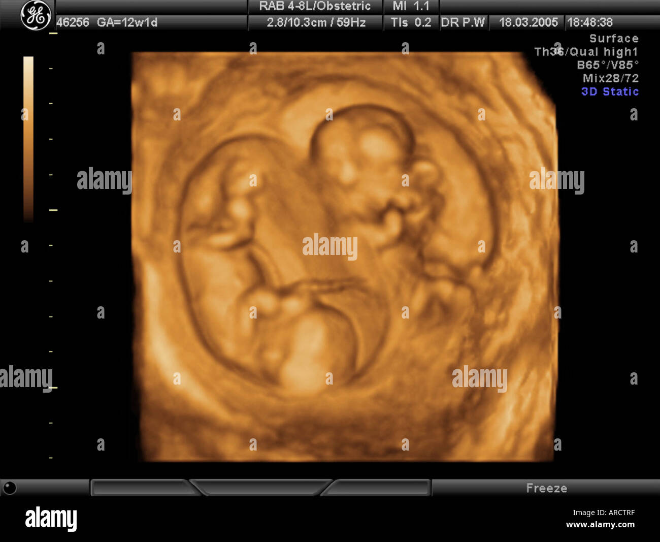 Echographie 3d Banque D Image Et Photos Alamy