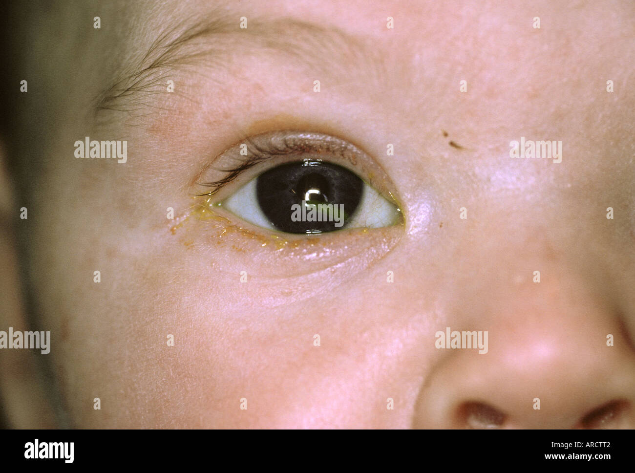 Abrasion de la cornée Banque de photographies et d’images à haute résolution Alamy