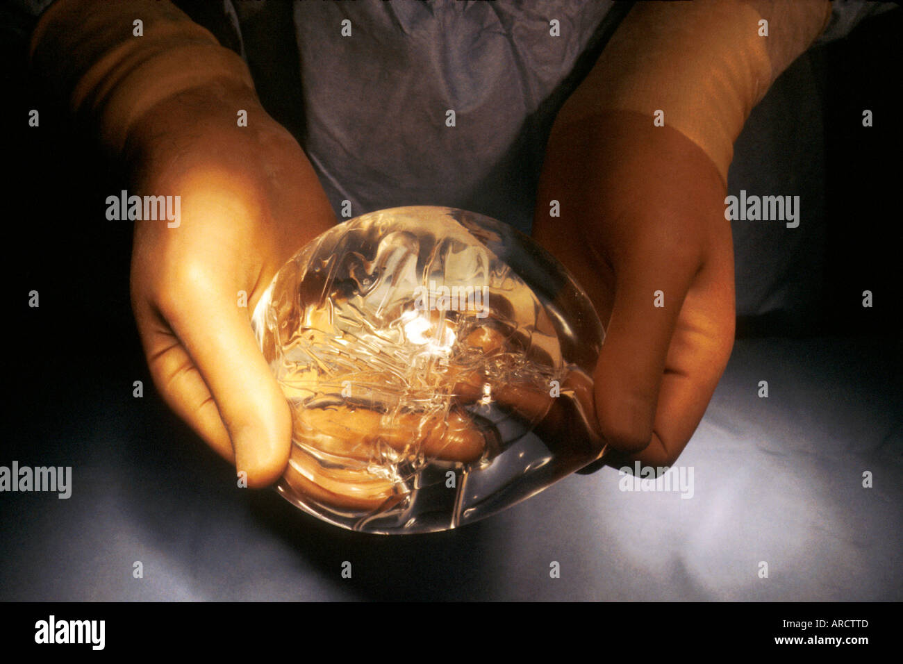 Une photographie d'un chirurgien titulaire d'un implant mammaire rempli de gel de silicone, utilisé pendant la chirurgie plastique ou esthétique d'augmenter ou de re Banque D'Images