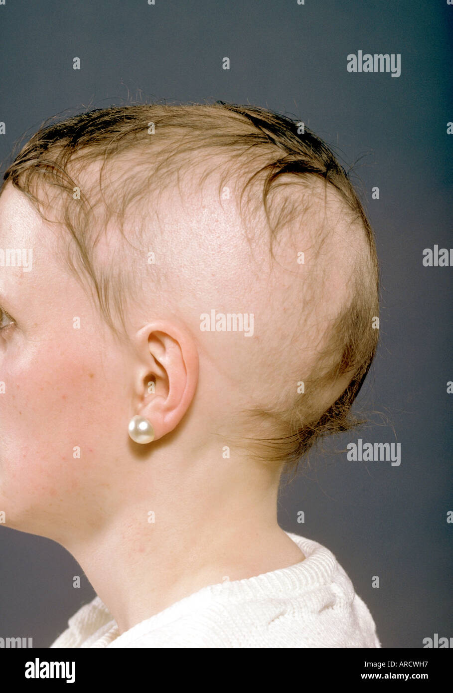 L'areata d'alopécie est un type de perte de cheveux que provoque généralement des parcelles de la calvitie. Dans certains cas, la calvitie totale développe Banque D'Images