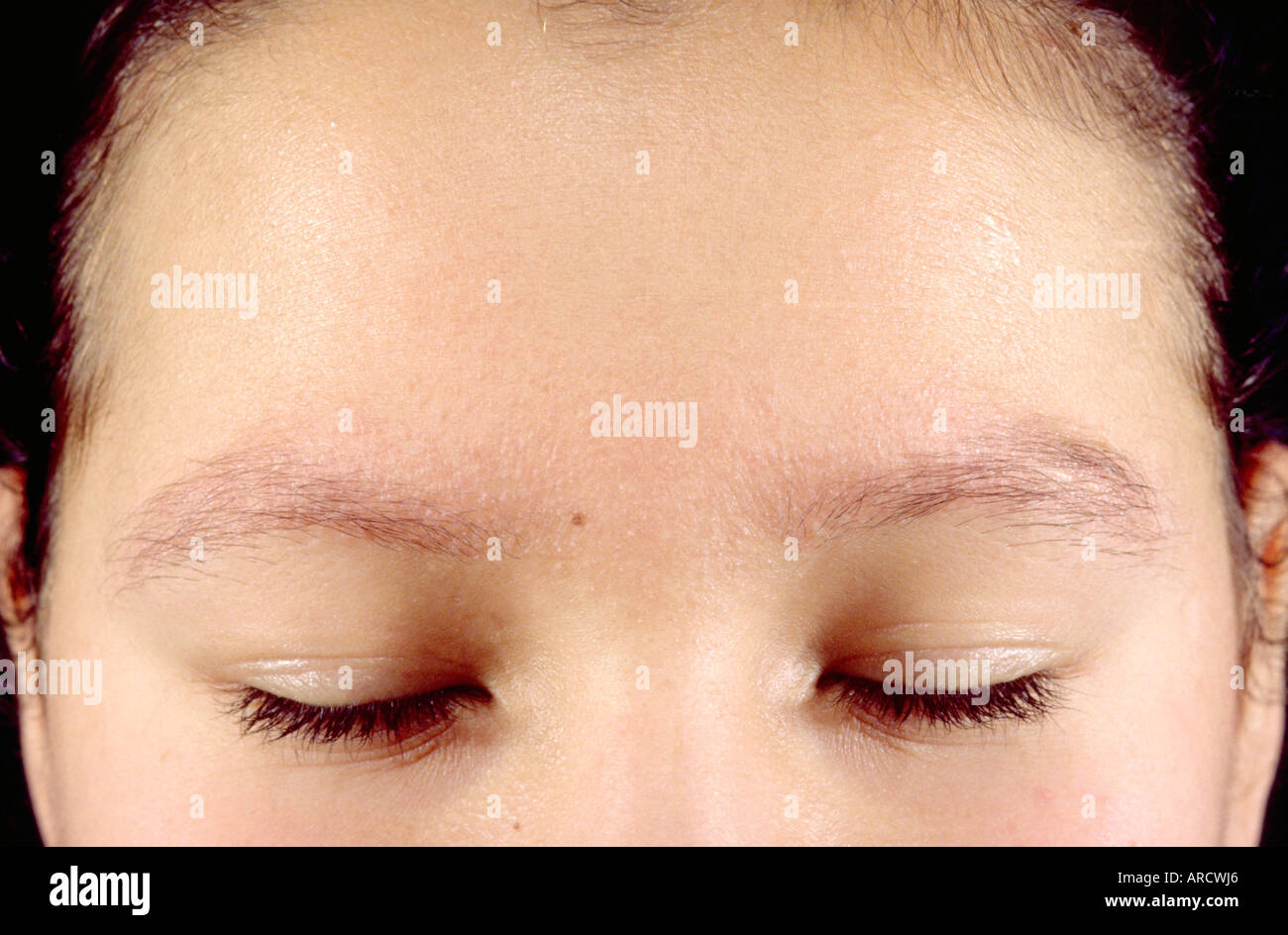 Une photographie d'une patiente avec f actinique. Banque D'Images