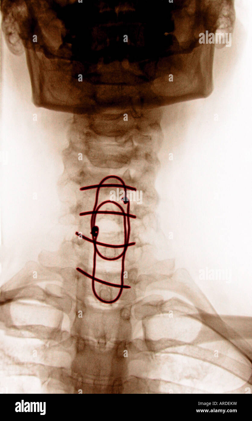 Rachis Cervical Radiographie D Une Femme De Ans Qui A Subi Une Chirurgie Pour Une Fracture Du