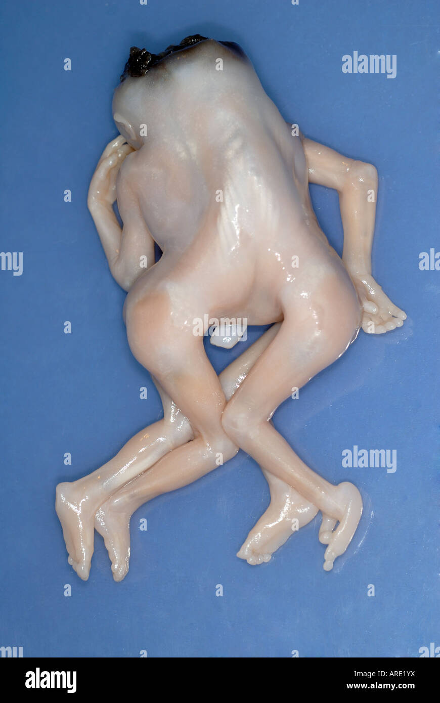 Jumeaux siamois Dipygus Banque D'Images