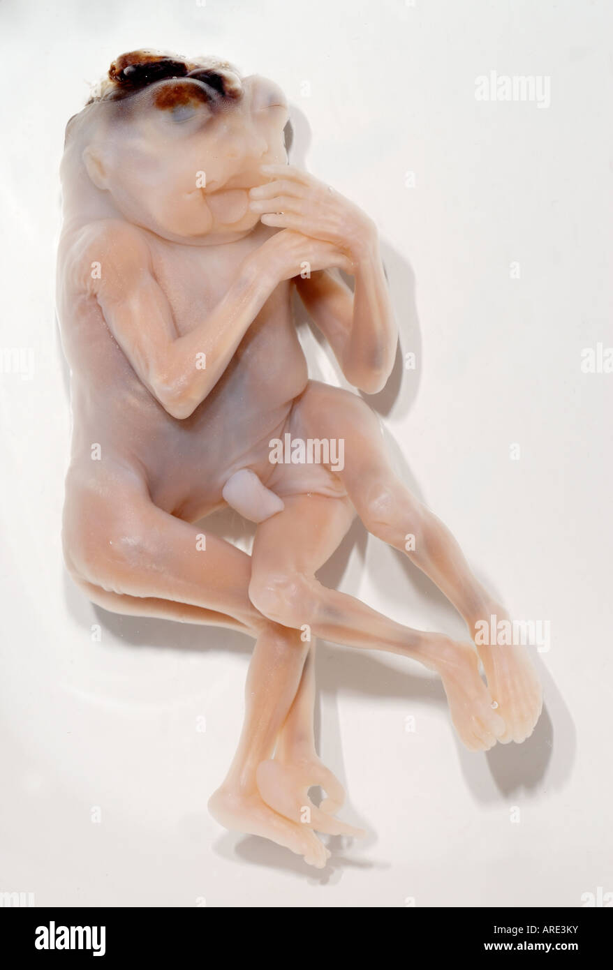 Jumeaux siamois Dipygus Banque D'Images