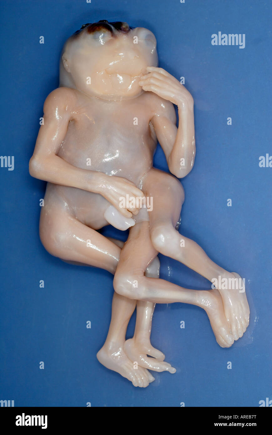 Jumeaux siamois Dipygus Banque D'Images