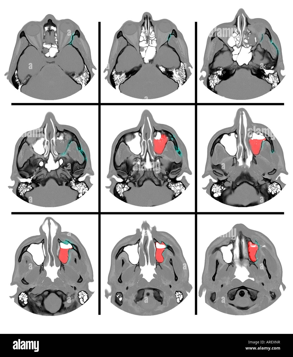 CT scan montrant une fracture du maxillaire supérieur Photo Stock - Alamy