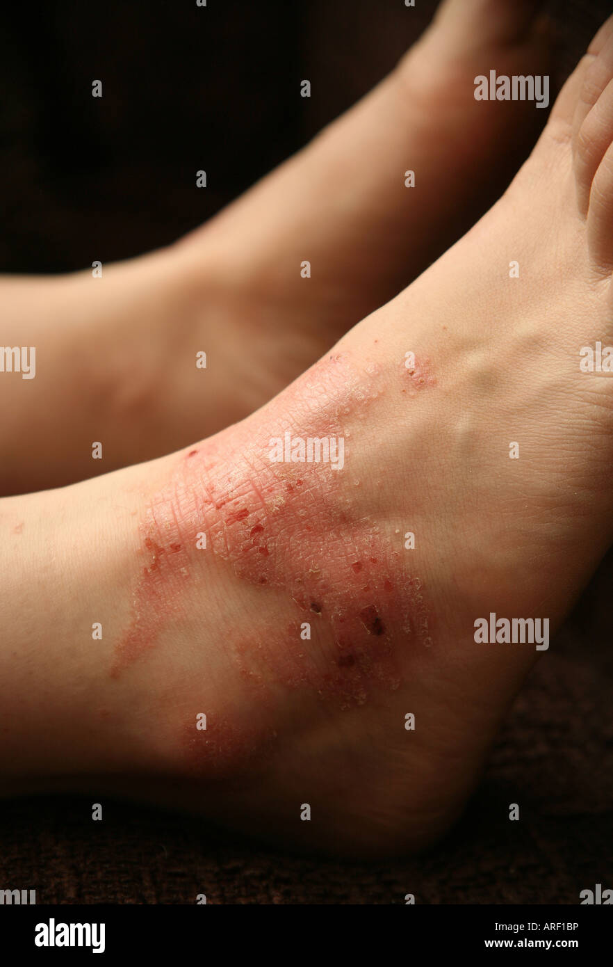 L'eczéma (dermatite allergique de contact) une réaction larmoyants yeux rouge Banque D'Images