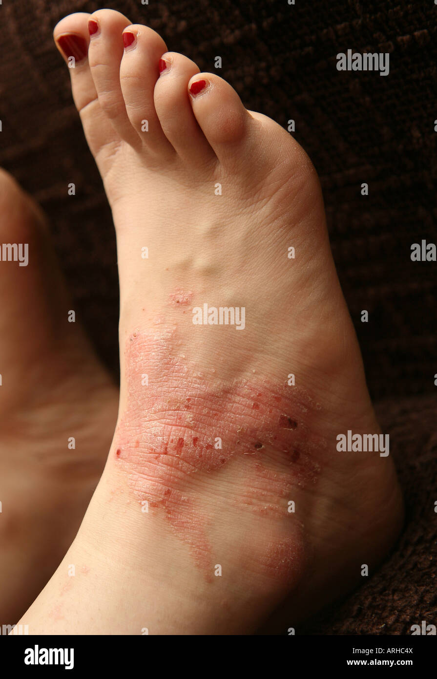 L'eczéma (dermatite allergique de contact) une réaction larmoyants yeux rouge Banque D'Images