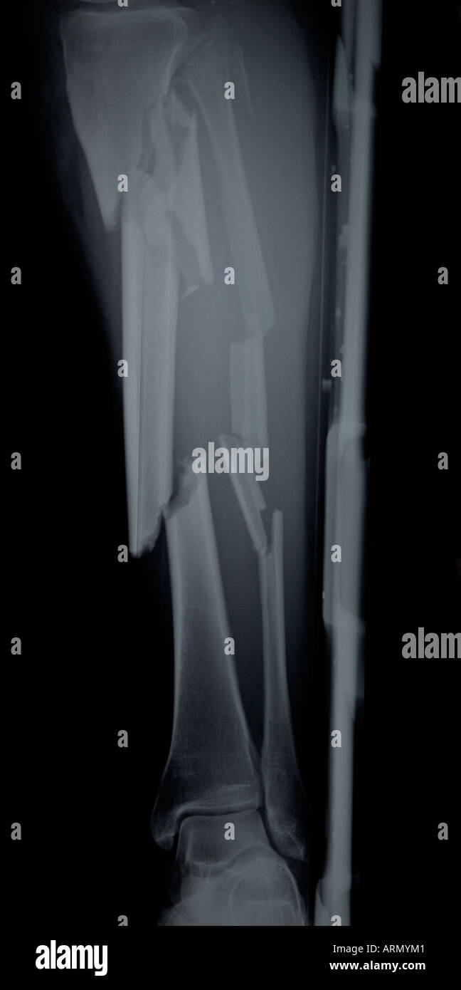 Table en croix x-ray de jambe brisée Banque D'Images