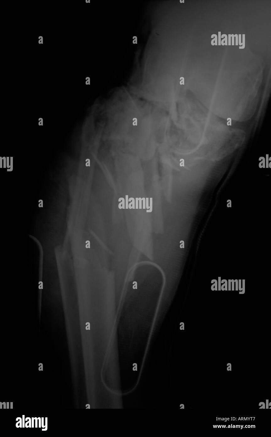 Vue frontale d'une fracture du genou brut Banque D'Images