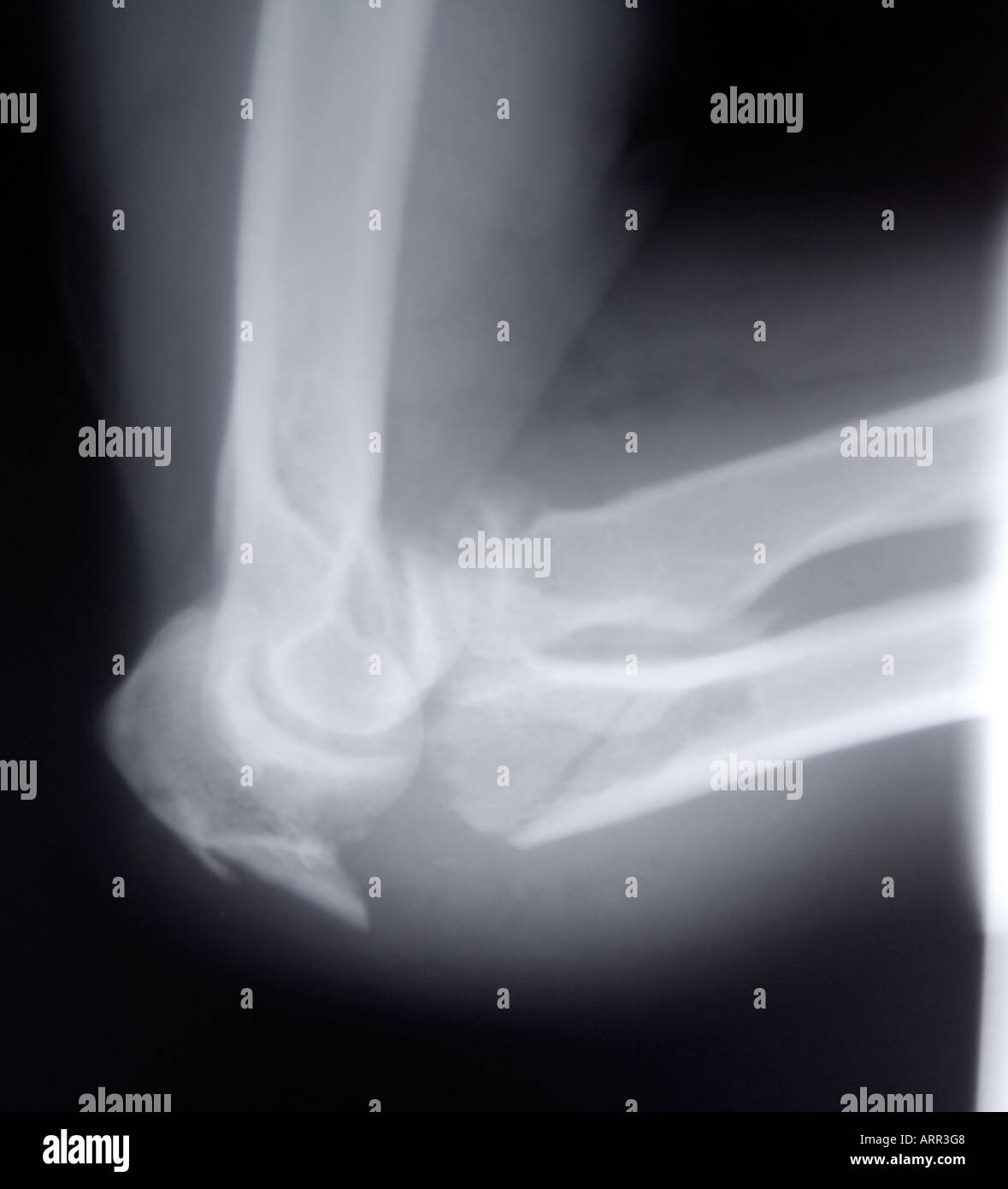 Fracture de la tête radiale Banque de photographies et d’images à haute ...