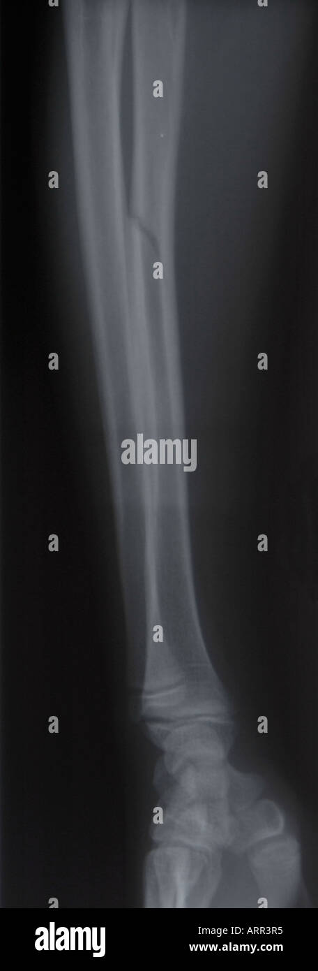 Radiographie latérale de l'avant-bras chez les enfants mineurs Banque D'Images