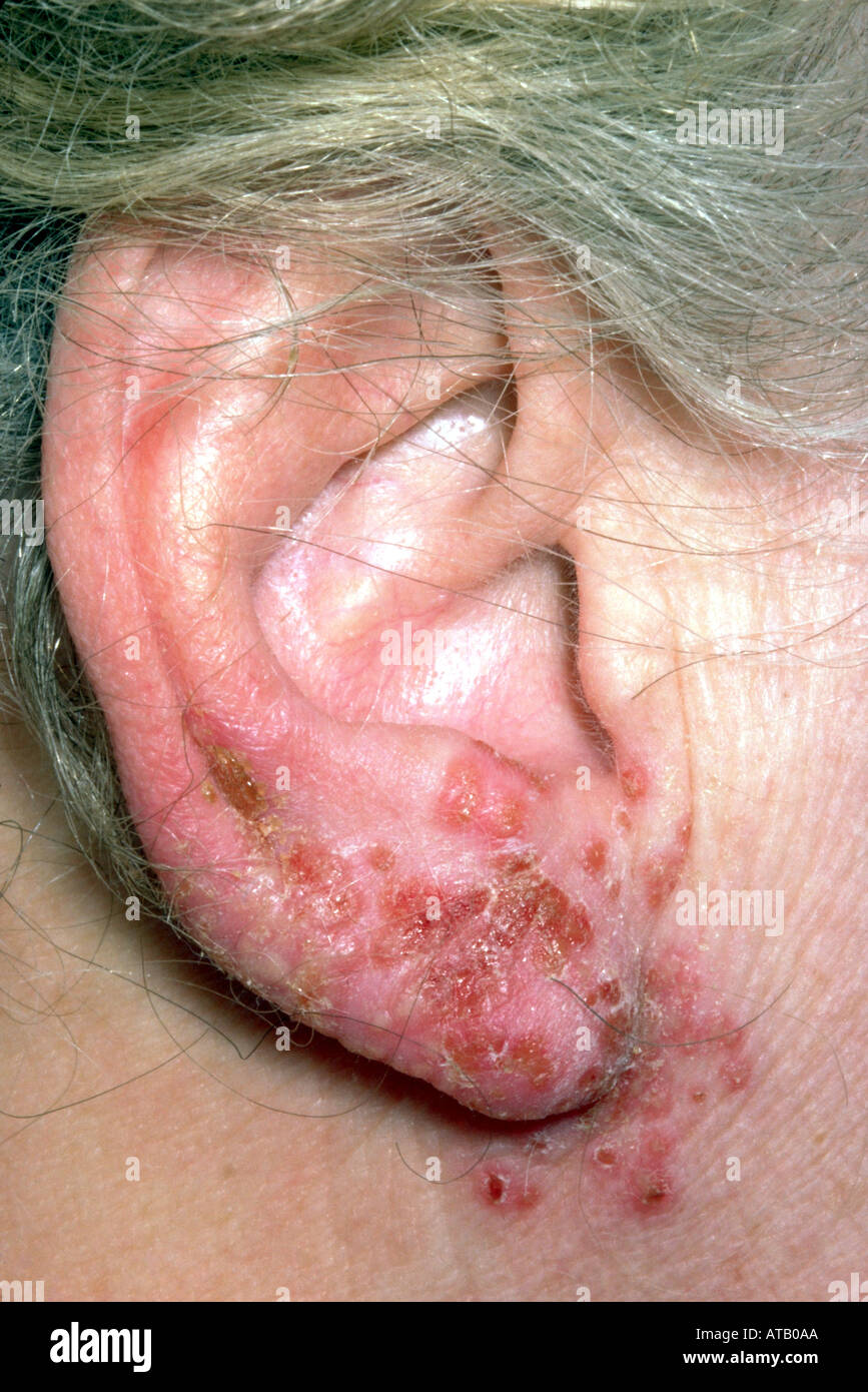 Impétigo Banque D'Images