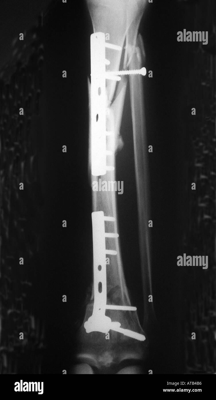 Fracture du tibia plaqué or Banque D'Images