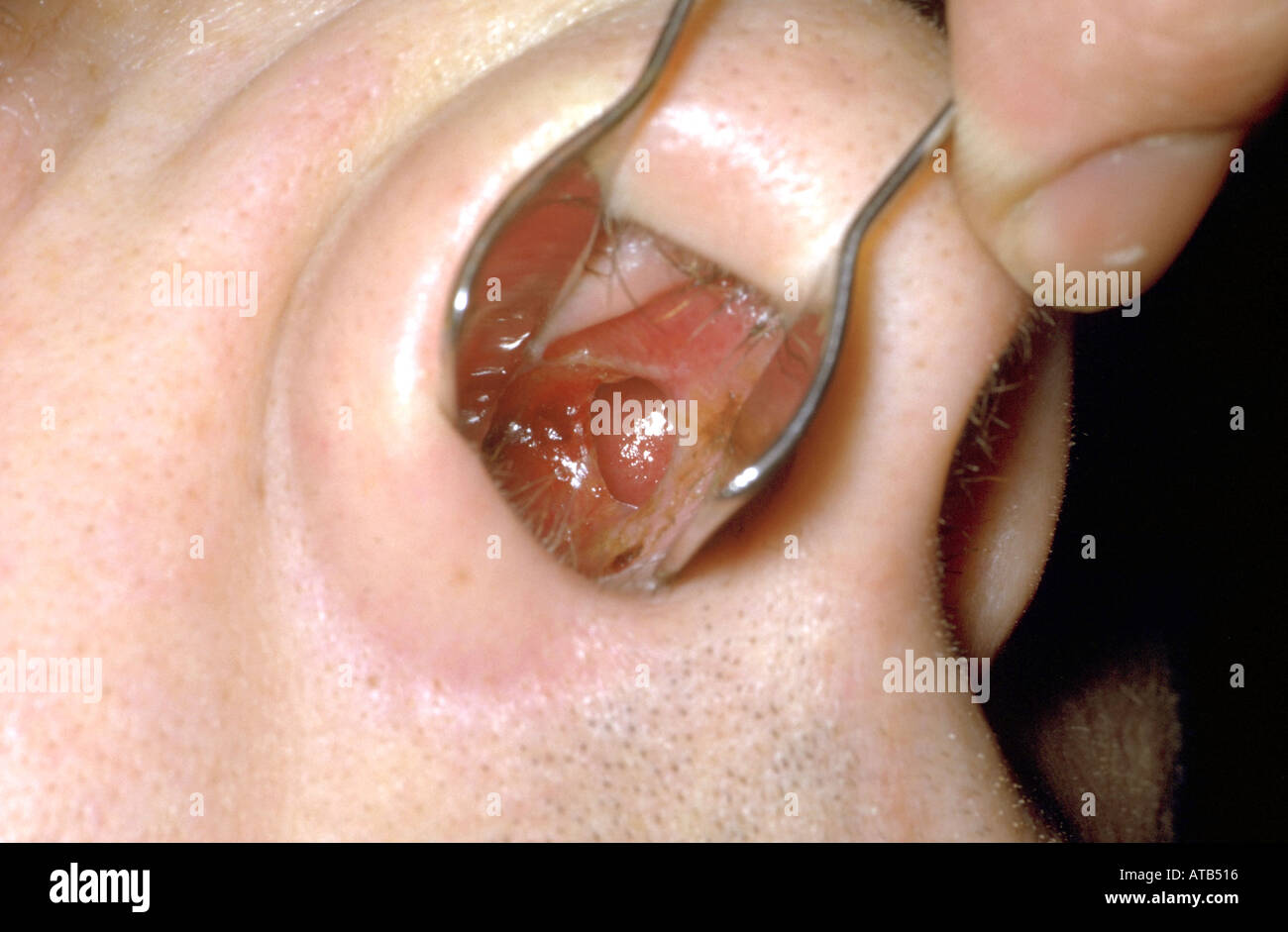 La perforation du septum nasal Banque D'Images
