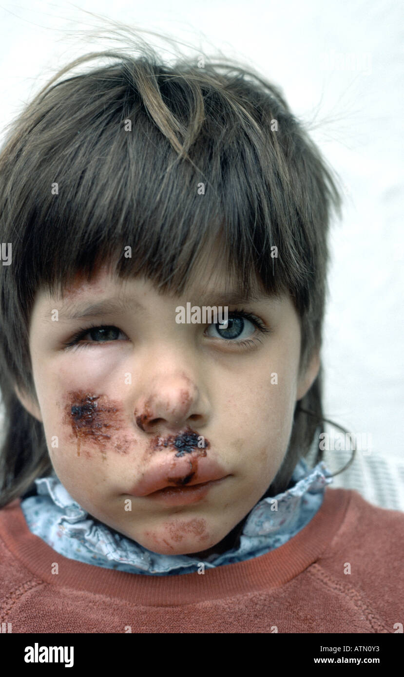 Les jeunes de l'enfant meurtri et gonflement du visage causées par dessus son guidon sur son vélo Banque D'Images