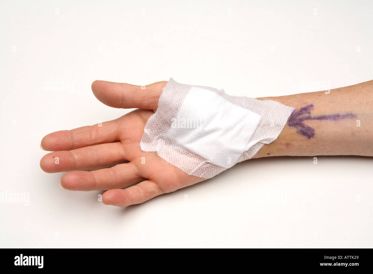 Habillé de la chirurgie du canal carpien poignet site opération Banque D'Images